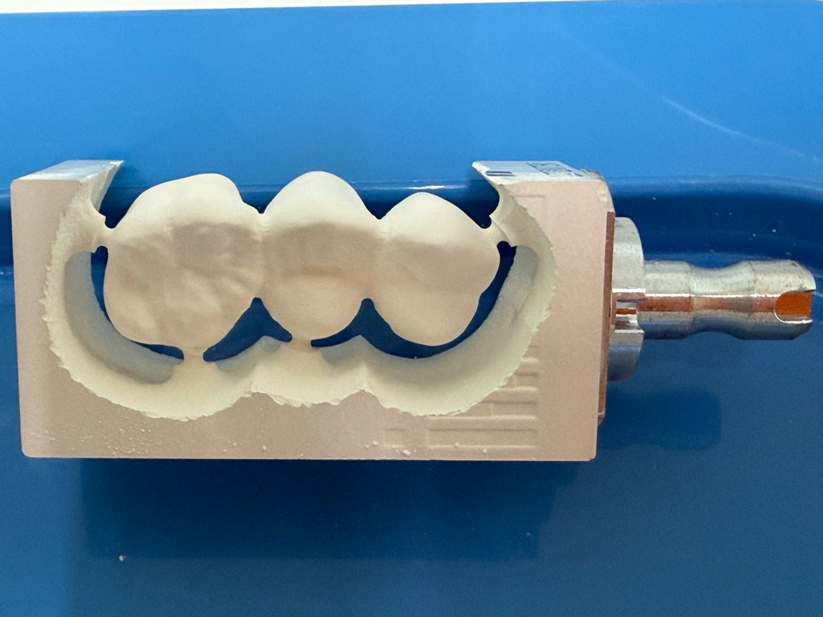Frisch gefräster Zahnersatz mit dem CEREC-System in der Praxis Fischer